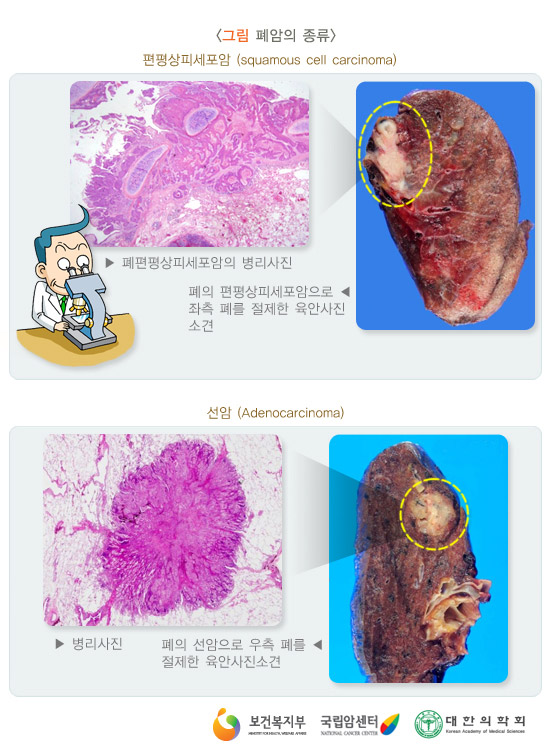 비소세포암의 종류