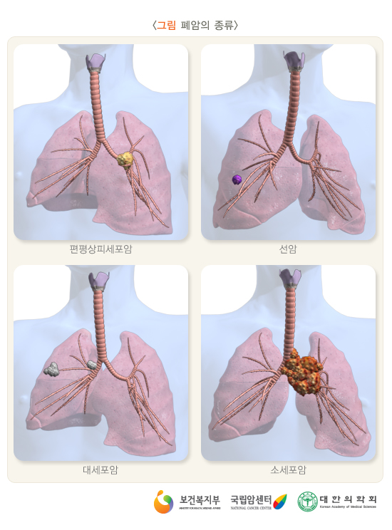 폐암의 종류