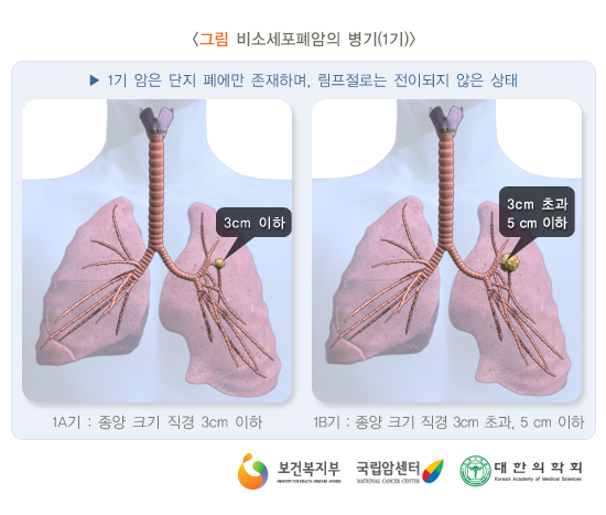 비소세포암의 병기(1기)