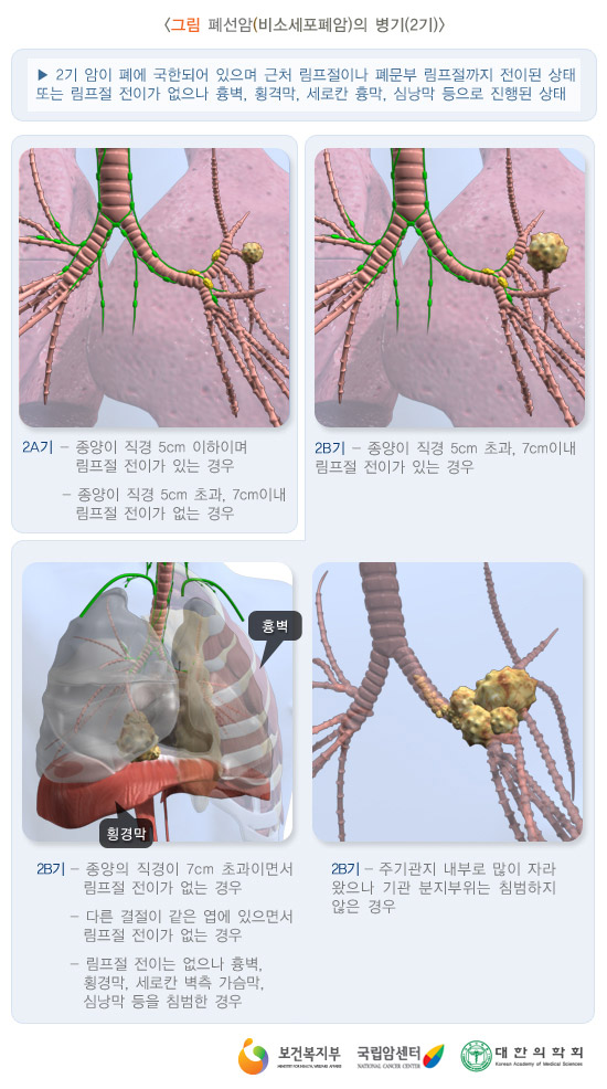 비소세포암의 병기(2기)