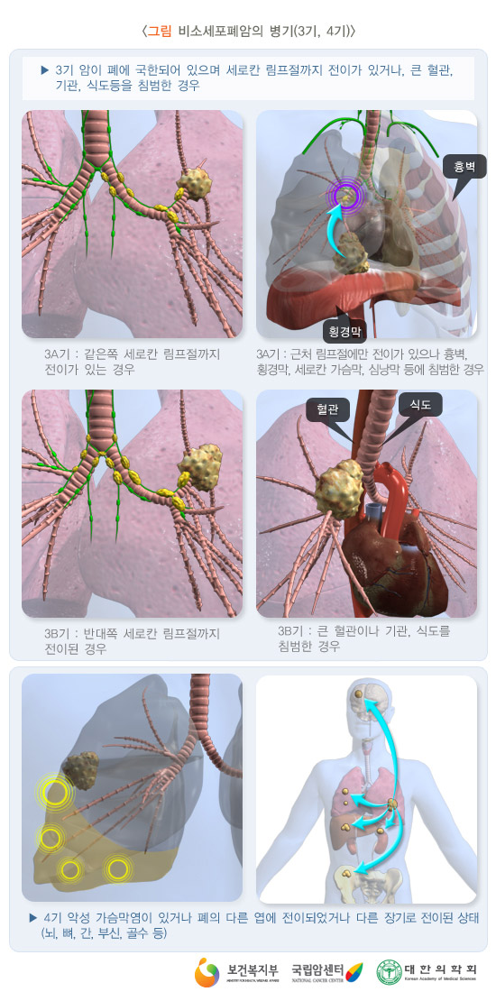 비소세포암의 병기(3,4기)