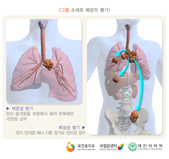 비소세포암의 병기(소세포 폐암의 병기)