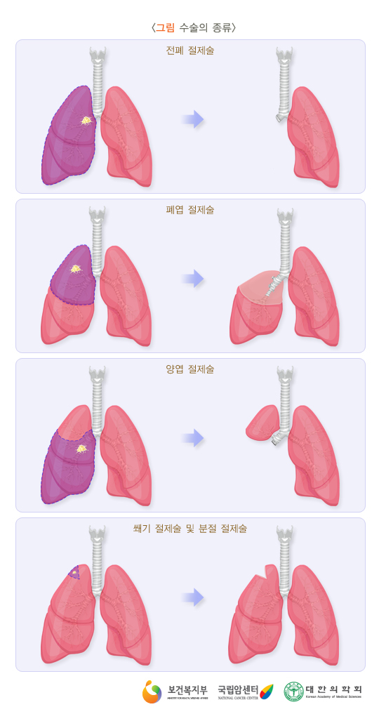수술의 종류)