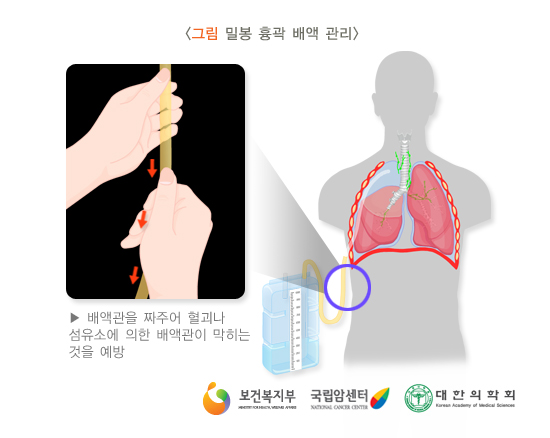 밀봉 흉곽 배액 관리