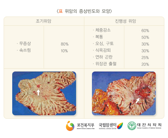 위암의 증상빈도와 모양
