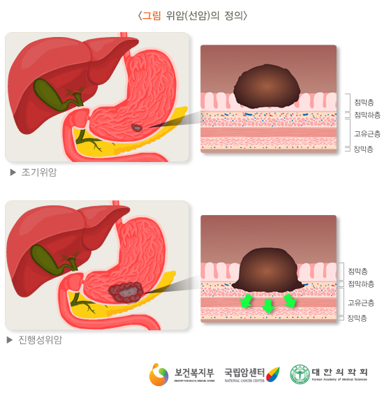 위암의 정의