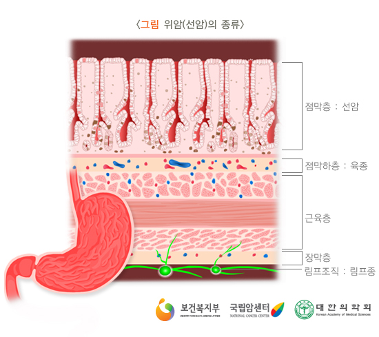 위암의 종류
