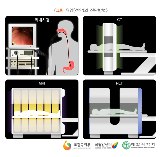 위암의 진단방법