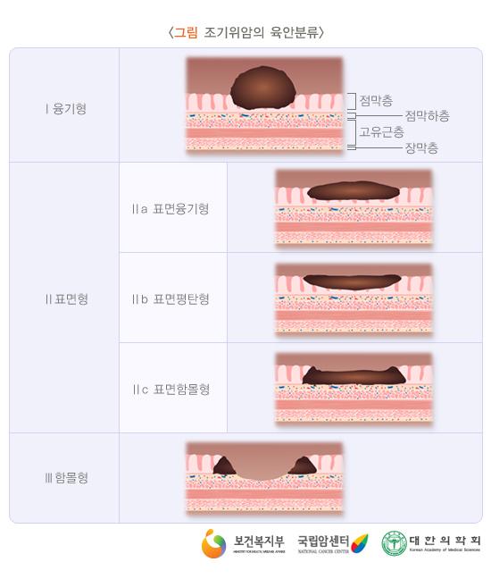 조기위암의 육안분류