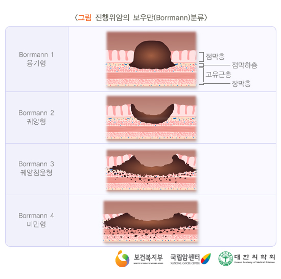 진행위암의 보우만(Borrmann)분류