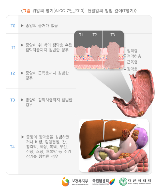 위암의 병기(AJCC 7판_2010) : 원발암의 침범 깊이(T병기)
