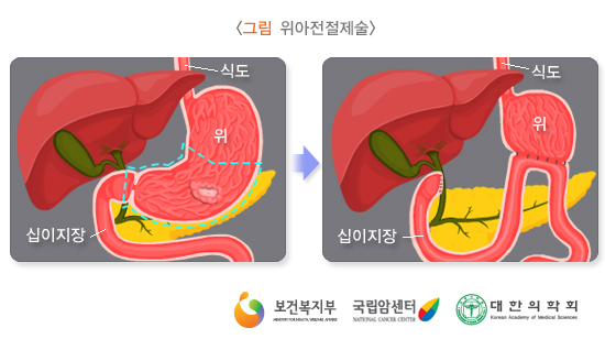 위아전절제술