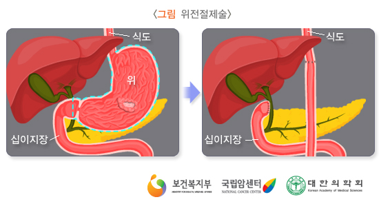 위전절제술