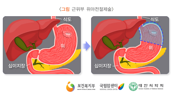 근위부 위아전절제술