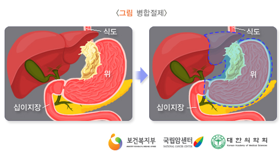 병합절제