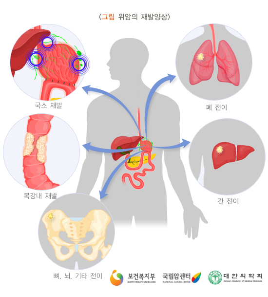 위암의 재발양상