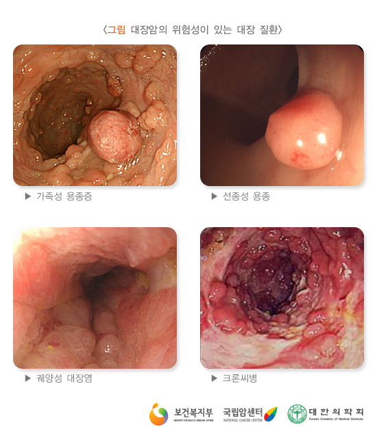대장암의 위험성이 있는 대장 질환