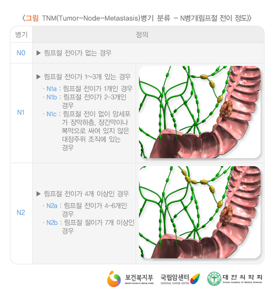 TNM(Tumor-Node-Metastasis) 병기 분류-N병기(림프절 전이 정도)