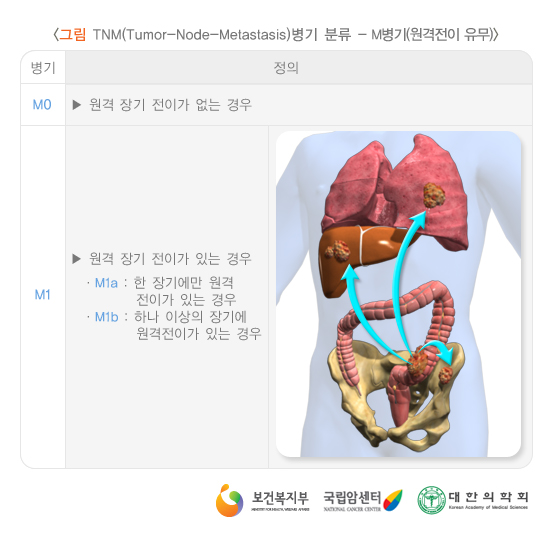 TNM(Tumor-Node-Metastasis) 병기 분류-M병기(원격전이 유무)