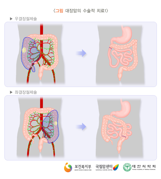대장암의 수술적 치료1