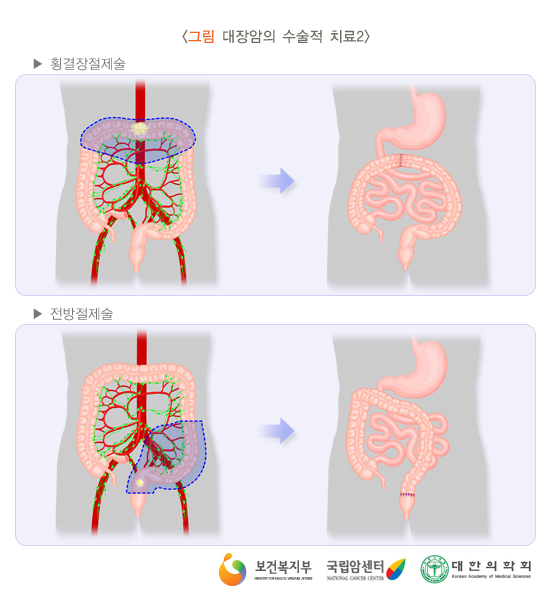 대장암의 수술적 치료2