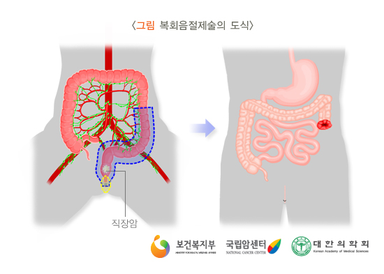 복회음절제술의 도식