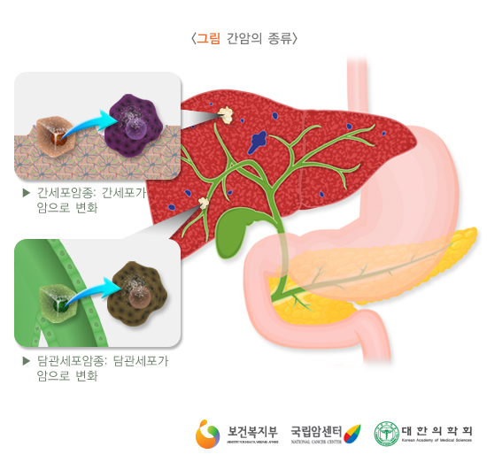 간암의 종류