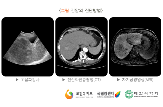 간암의 진단방법