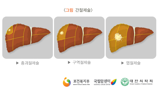 간절제술