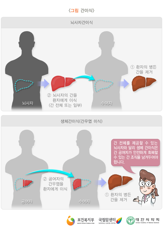 간이식