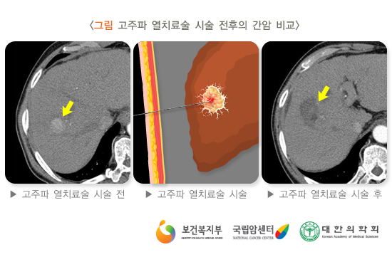 고주파 열치료술 시술전후의 간암비교