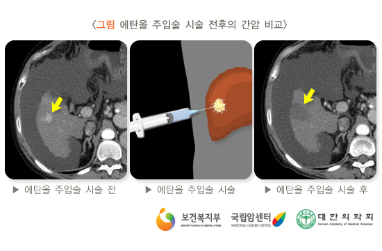 에탄올 주입술 시술 전후의 간암비교