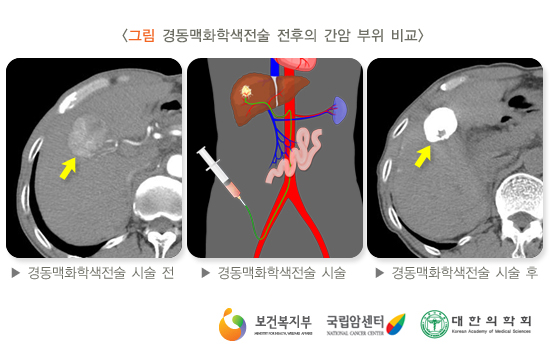 경동맥 화학색전술 전후의 간암부위 비교