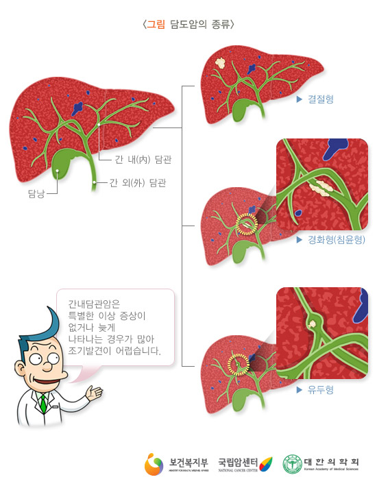 담도암의 종류