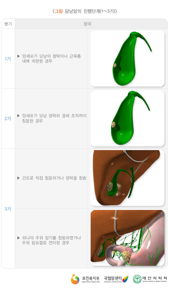 담낭암의 진행단계(1~3기)