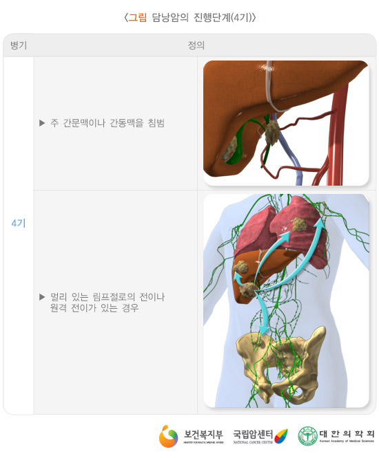담낭암의 진행단계(4기)