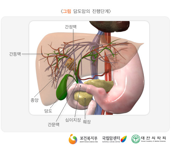 담도암의 진행단계