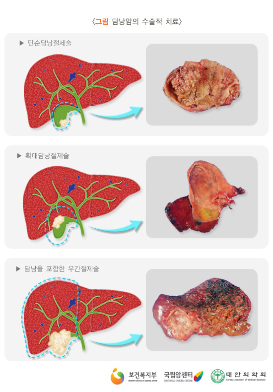 담낭암의 수술적 치료