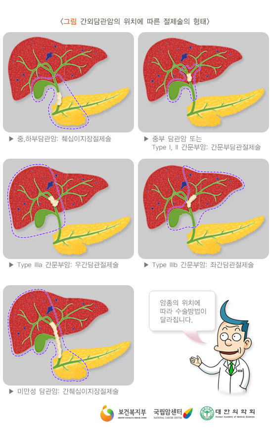 감외감관암의 위치에 따른 절제술의 형태