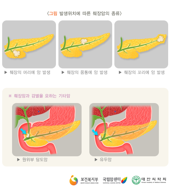 발생위치에 따른 췌장암의 종류