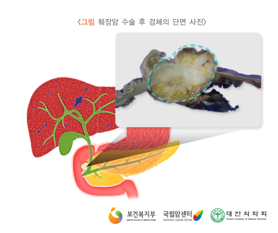 췌장암 수술 후 검체의 단면 사진