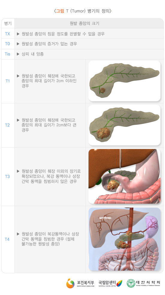 T(Tumor) 병기의 정의