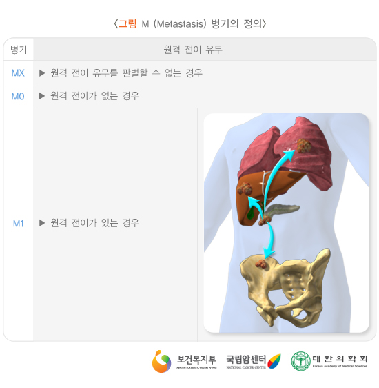 M(Metastasis) 병기의 정의