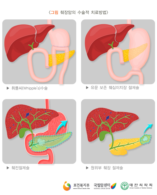 췌장암의 수술적 치료방법