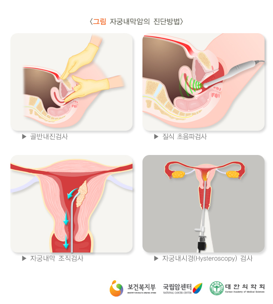 자궁내막암의 진단방법